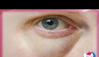 Las bolsas en los ojos no existirán con estos remedios caseros
