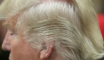 Donald Trump y los peligrosos efectos de la medina que toma para evitar la caída del cabello