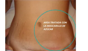 Cómo eliminar estrías con azúcar