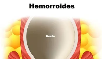 Remedios caseros para las almorranas