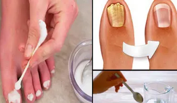 Ningún remedio es más efectivo como este â??Rompe Hongosâ?