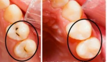 Conoce estos tips para tratar los huecos en los dientes sin ir al dentista 
