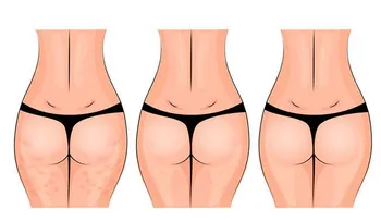 Crema casera para la flacidez de caderas y muslos
