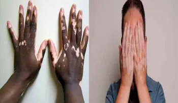 Millones en el Mundo celebran aparición nueva cura para el vitiligo
