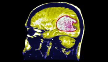 Número de tumores cerebrales se duplicó en Inglaterra y preocupa el uso de teléfonos móviles
