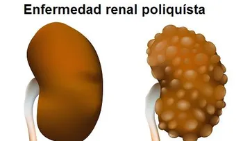 Causas de la insuficiencia renal y cómo tratarla naturalmente