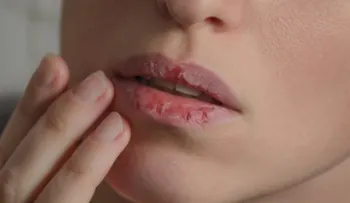 Anota estos  5 remedios para aliviar la boca seca 