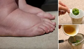 6 remedios que funcionan para deshinchar tobillos, pies y piernas