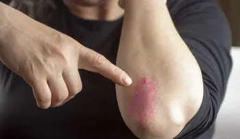 En la artritis psoriásica, cuanto antes empiece la terapia, mejor