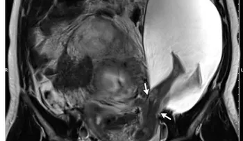 El extraño descubrimiento de un médico en el útero de una paciente: El niño está vivo y todavía patea