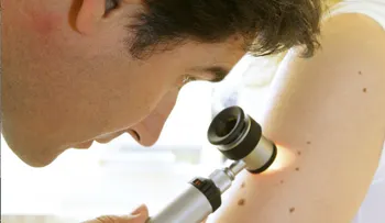 Número de lunares en el brazo derecho podría predecir riesgo de sufrir melanoma