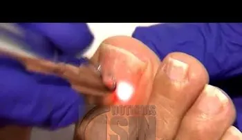  Síndrome de uñas feas, condición muy común que afecta los pies 