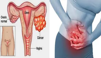  Las 3 hierbas que han curado a muchas mujeres de cáncer uterino, según Dra. Universidad de Chile