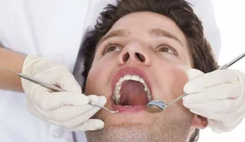 Sellador dental, ¿una solución para evitar caries?
