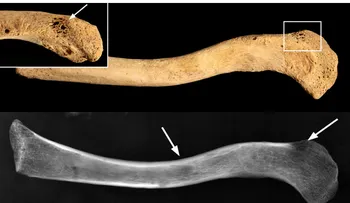 Hallan un cáncer de más de 3.000 años