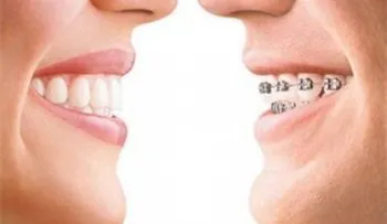 7 mitos y realidades sobre la ortodoncia