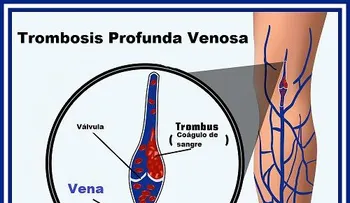 Coágulos en la sangre y signos inusuales que debes saber