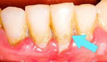 El sarro dental. Remedios para eliminarlo