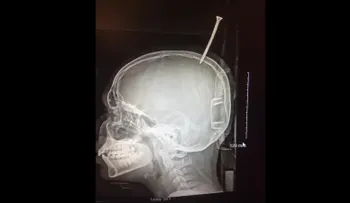 Logran salvar a Natanael García), el hombre que se perforó la cabeza con un clavo porque alegadamente sentía el cerebro flojo