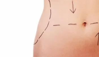 Seis preguntas típicas sobre la lipoaspiración