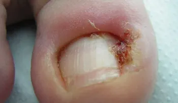 6 remedios caseros para aliviar las uñas encarnadas