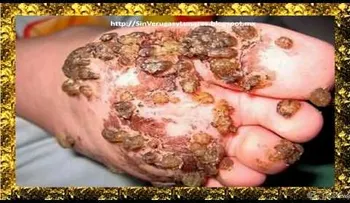 Una forma rapidísima de eliminar Lunares y Verrugas  (VIDEO)
