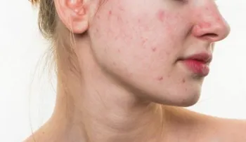 5 hábitos alimenticios que pueden destruir tu rostro