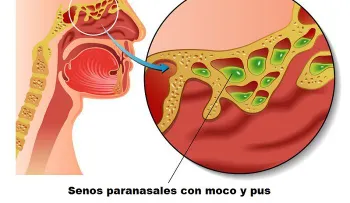 Cómo curar la infección sinusal con vinagre de sidra de manzana