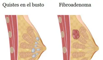 Qué son los bultos en los senos y signos de alarma
