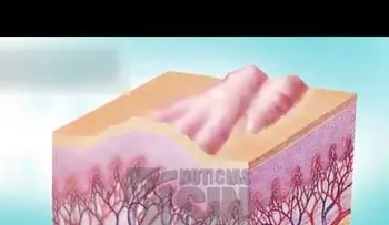 Queloide: Una formación en la piel que se hace encima de una cicatriz 