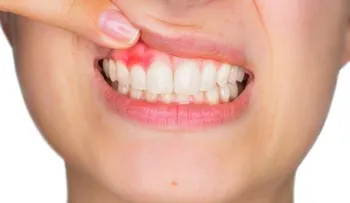 La gingivitis: causas, síntomas y tratamiento
