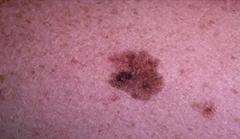 Pueden predecir respuesta a inmunoterapia en pacientes con melanoma