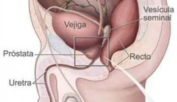 Consejos del doctor Manuel Lazaete para desinflamar la próstata con medicina natural