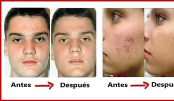 Cura para el acné de forma natural y para siempre
