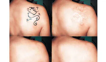 ¿Se pueden quitar los tatuajes sin lesionar la piel?