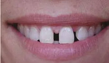 Si tiene los dientes separados tiene que leer esto URGENTEMENTE