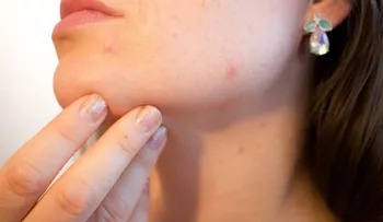 Investigadores habrían encontrado una vacuna efectiva contra el acné