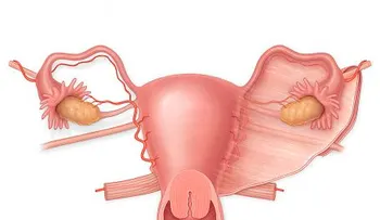 Los miomas uterinos: Todo lo que deberías saber y nadie te lo ha dicho