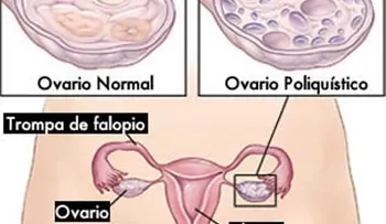 Este poderoso remedio te ayuda a combatir los ovarios poliquísticos.¿Qué necesitas?