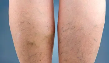 Elimina las varices con esta mezcla de aloe vera, zanahoria y vinagre