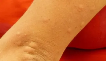 Formas naturales para vencer la urticaria o picazón
