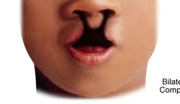 ¡Entérate! Operación del labio leporino alivia varios problemas