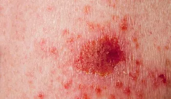 Tipos de cáncer de piel y cómo detectarlos