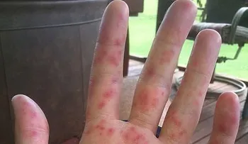 Alertan nuevo virus que afecta niños y adultos; se pega con un esturnudo, beso o apretón de manos