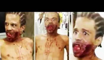 FUERTES IMAGENES: Un hombre con un disparo en la cara aterroriza Brasil 