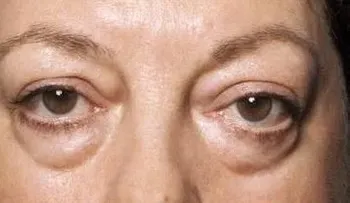 ¿Qué hacer cuando despiertas con los ojos hinchados?