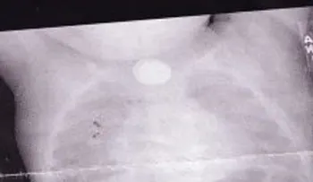 Este niño comienza a sentirse muy enfermo, hasta que una radiografía revela el motivo