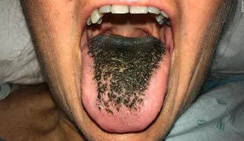 ¿En qué consiste la extraña condición de la lengua "peluda" negra?