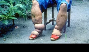 Causas de la Elefantiasis