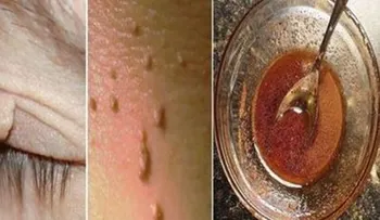 Elimina fácilmente cualquier fibroma o verruga de la piel en tan solo 1 semana sin dejar manchas!! funciona en todos los casos!!